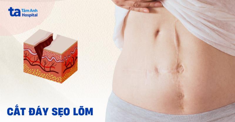 Quy trinh su dung kem tri seo ro hieu qua tung buoc